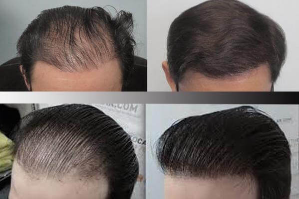 انواع روش های کاشت موی سر